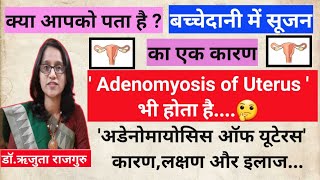 Adenomyosis of Uterus in hindi Uterine adenomyosisबच्चेदानी में सूजन क्यों होता है BulkyUterus [upl. by Anait]