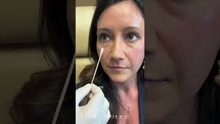 Removing Under Eye Filler Journey  with Dr Kami Parsa [upl. by Drareg]