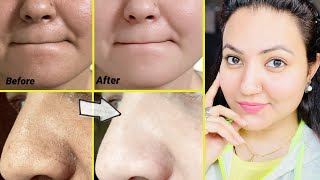 कितने भी मुश्किल Blackheads Whiteheads कील सफेद दाने हों follow करें ये 5 steps और पाएँ चमकदार skin [upl. by Rania674]