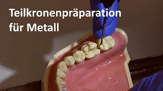 Präparation der Metallteilkrone Teilkronenpräparationen für Metall 4K [upl. by Eanod]