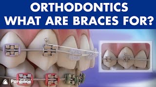 How Braces Work Elements of the orthodontic treatment and its role © [upl. by Allehc]