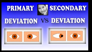 Primary Deviation Vs Secondary Deviation  Squint Simplied for Medical Students [upl. by Yuille869]