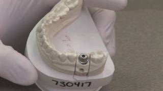 Dental Implants Explained [upl. by Eluk]