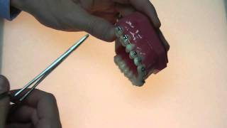 Common orthodontic emergencies Loose wire [upl. by Bigler25]