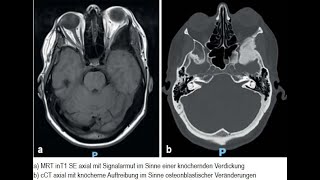 Osteodystrophia deformans Paget mit einseitigem Exophthalmus [upl. by Hpeosj231]