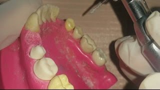 Introduction in fixed prosthodontics [upl. by Acile]