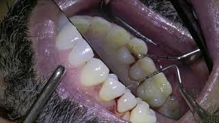 IMMEDIATE IMPLANT PLACEMENT IN CLASS 2B SOCKET [upl. by Inanuah]