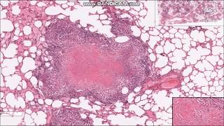 Tuberculosis Granulomas  Histopathology slides [upl. by Nesmat]