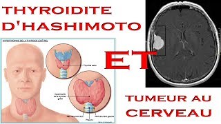 Mes problèmes de santé Thyroïdite dhashimoto et Tumeur au cerveau [upl. by Aicnarf]