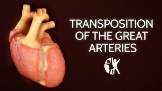 Transposition of the Great Arteries [upl. by Nottnerb530]