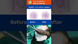 Circumcision surgery Stapler PhimosisSwollen Penis Treatment hospital doctor hyderabad [upl. by Michella]