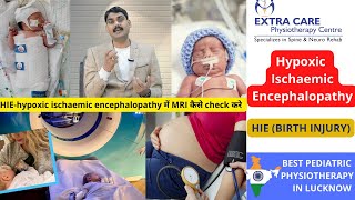 Hypoxic Ischaemic Encephalopathy  HIE in Babies Birth Injury  Pediatric Physiotherapy in Lucknow [upl. by Ennyleuqcaj536]