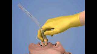 Laryngeal Mask Airway Insertion [upl. by Blanka]