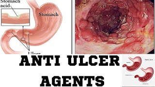 Anti Ulcer AgentsPPIH2 RECEPTOR ANTAGONISAMHARIC TUTORIAL [upl. by Nanice]