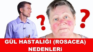 Gül Hastalığı Rosacea Nedenleri ve Tedavisi [upl. by Enitsed554]