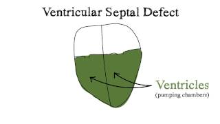 Ventricular Septal Defect VSD [upl. by Jason]