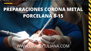 🦷Preparación de Coronas Metal Porcelana👅 815 Colocación de 2do Hilo Retractor [upl. by Llemor694]