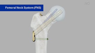 Femur Neck—Fracture 31B—Stabilization Using the Femoral Neck System FNS [upl. by Steady]