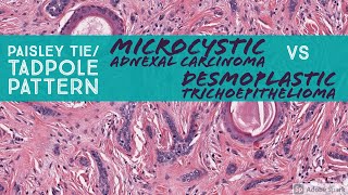 Microcystic Adnexal Carcinoma vs Desmoplastic Trichoepithelioma Paisley TieTadpole Pattern [upl. by Yerffej]