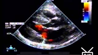 The EchoWeb Youtube Archives  3 Cardiac Conditions [upl. by Atilrak]