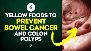 6 Yellow Foods To Prevent Bowel Cancer And Colon Polyps [upl. by Ahsenad683]