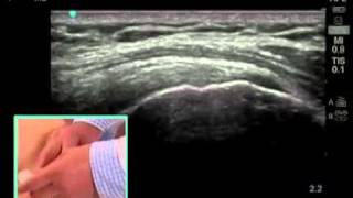 How To Ultrasound Guided Shoulder Injection Scanning Technique Video [upl. by Roer460]