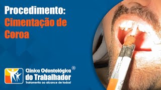 PROCEDIMENTO Cimentação de Coroa [upl. by Alcine]