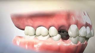 Removing Teeth for Braces  Why Extracting and Retracting Orthodontics is harmful [upl. by Ajnin]