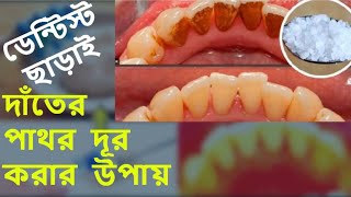 ডেন্টিস্ট ছাড়াই দাঁতের পাথর দূর করার উপায়  how to remove tartar at home  bangla health tips [upl. by Bushore]