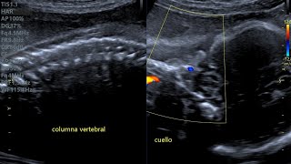 EMBARAZO DE 32 SEMANAS NO SE PUDO VER EL SEXO FETAL DEBIDO A QUE TRAÍA CRUZADAS LAS PIERNAS 🥲 [upl. by Medwin]