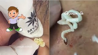 The Ultimate Compilation Ear Blackhead Removal Extravaganza Pimple pooping [upl. by Lodi164]