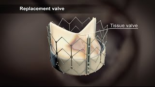 TAVI Transcatheter Aortic Valve Implantation [upl. by Sharos]