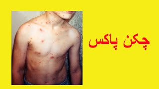 Chicken Pox Information in Urdu [upl. by Nessi]