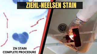 Ziehl Neelsen StainAcid Fast StainZN StainZiehl Neelsen Stain ProcedureAdnanMLT [upl. by Adahs761]