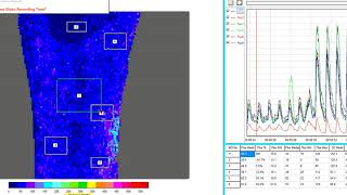 Firefly Recovery Clinical Video using Laser Speckle Analysis [upl. by Raila]