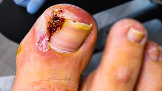 JUICY INFECTED INGROWN TOENAIL SURGICAL TOENAIL REMOVAL [upl. by Hurst422]