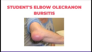 Students Elbow  Olecranon Bursitis  PhysiotherapyKnowledge [upl. by Gennaro]