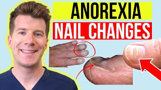 6 finger nail changes seen in ANOREXIA  Doctor explains [upl. by O'Reilly675]