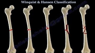 Fractures Of The Femur Shaft Winquist amp Hansen  Everything You Need To Know  Dr Nabil Ebraheim [upl. by Fanchan]