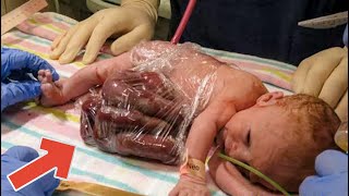 Baby born with organs outside the body [upl. by Rodney262]