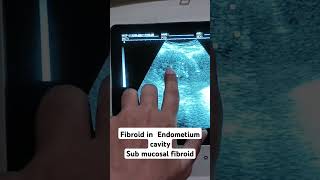 Endometrium fibroid sub mucosal shortyoutubevideo loveultrasound pregnant pregnant [upl. by Gordon]