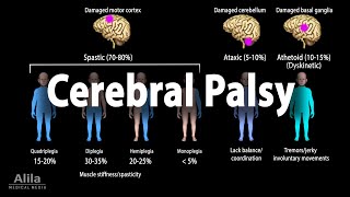 Cerebral Palsy Animation [upl. by Osana]