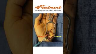 Treatment of Guyon’s canal syndrome Ulnar tunnel syndrome shorts [upl. by Nodle]