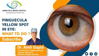 Pinguecula Yellow Spot in Eye What to do [upl. by Auoh]