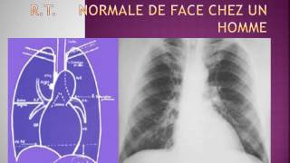 CARDIOLOGIE Interprétation d’une radiographie thoracique [upl. by Northrup]