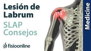 Consejos para solucionar la lesión labrum de hombro SLAP [upl. by Dorrej]