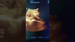 Placenta previa  Low Lining placenta previa pregnancy ultrasound pregnant mbbs shorts video [upl. by Laszlo62]