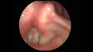 vocal atrophy with sulcus vocalis post laryngoplasty 聲帶萎縮合併聲帶溝手術後 [upl. by Eimrej428]