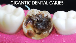 INCREDIBLY SATISFYING Restoration Of Massive Tooth Decay  Root Canal And Crown Process [upl. by Ramhaj671]