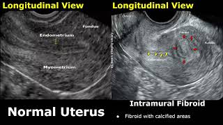 Uterus Ultrasound Normal Vs Intramural Fibroid Images  Uterine Leiomyomas USG Cases [upl. by Mavis]